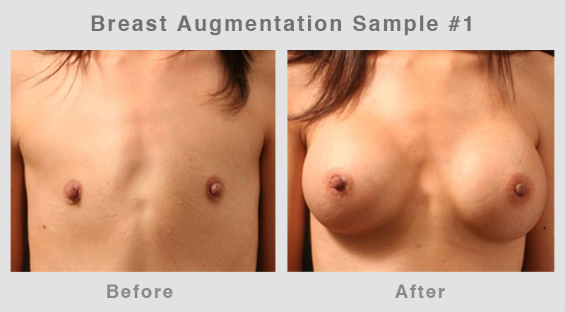 Breast Augmentation Before & After Picture 1
