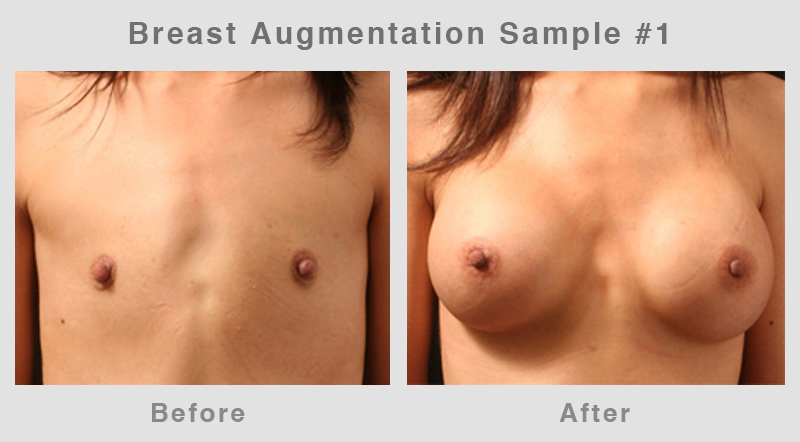BreastAugSample1 Breast Augmentation Before & After Picture 1