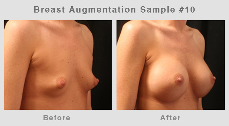 Breast Augmentation Before & After Picture 10