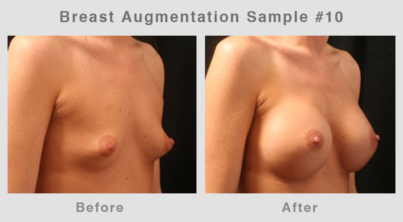 BreastAugSample10 Breast Augmentation Before & After Picture 10