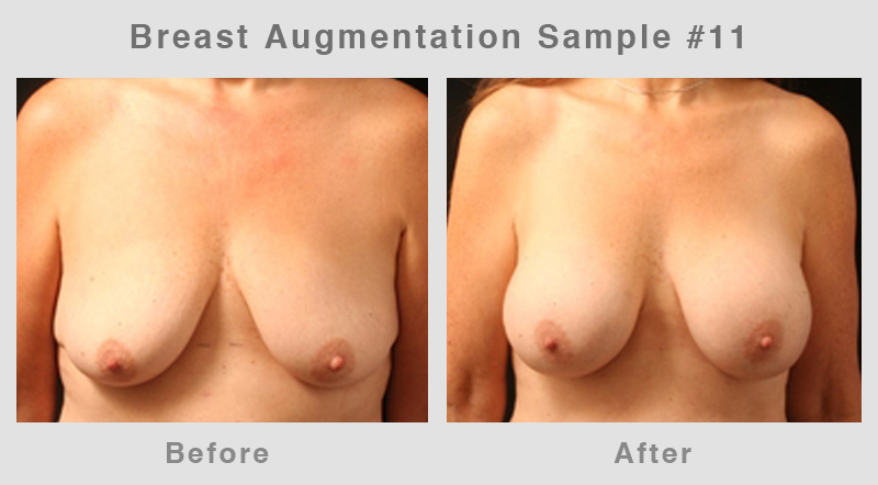 Breast Augmentation Before & After Picture 11