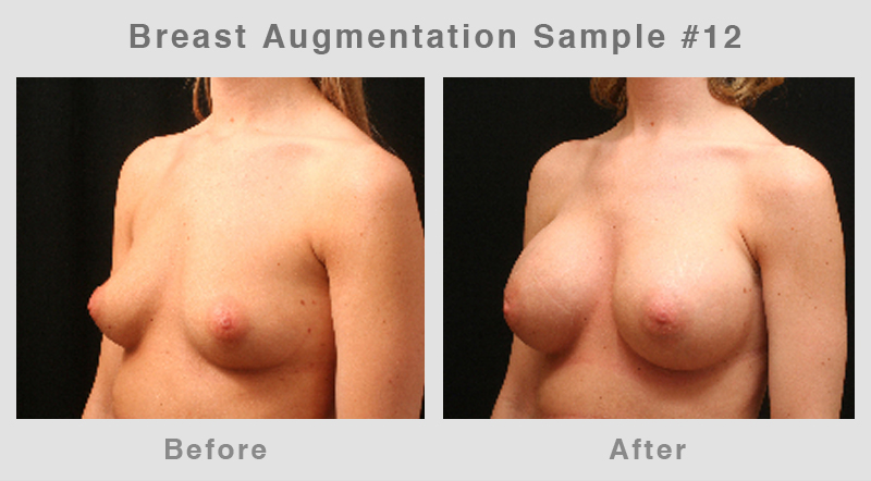 Breast Augmentation Before & After Picture 12