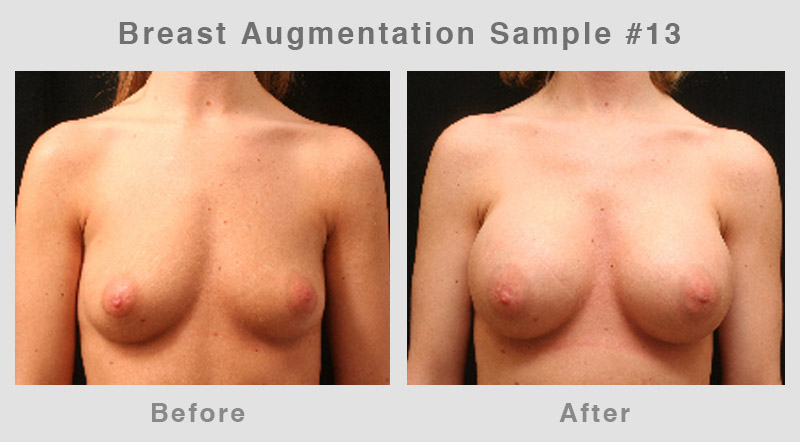 Breast Augmentation Before & After Picture 13