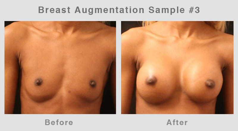 Breast Augmentation Before & After Picture 3
