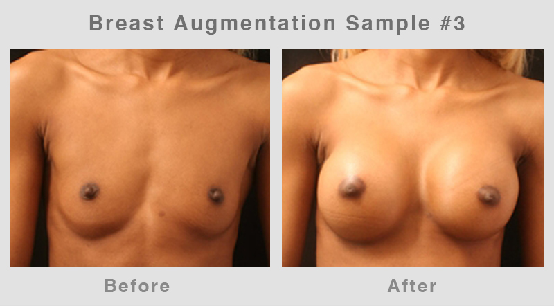 BreastAugSample3 Breast Augmentation Before & After Picture 3