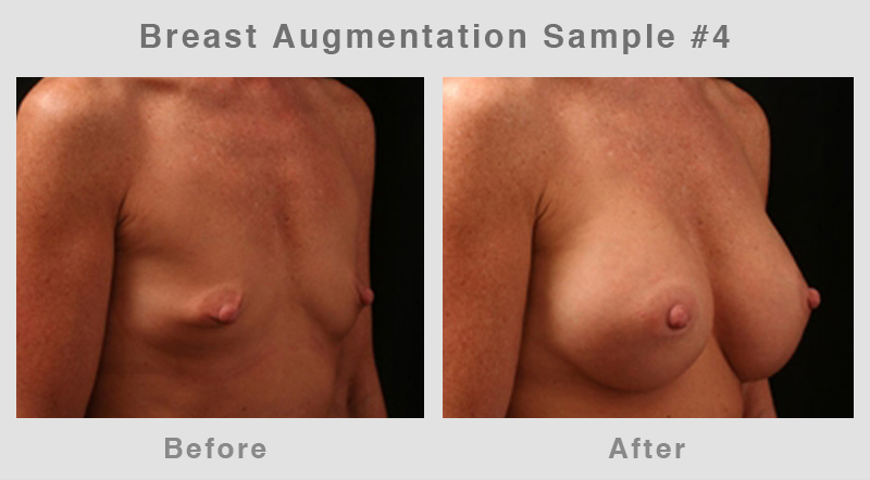 Breast Augmentation Before & After Picture 4