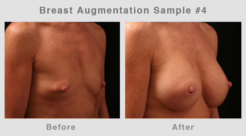 BreastAugSample4 Breast Augmentation Before & After Picture 4