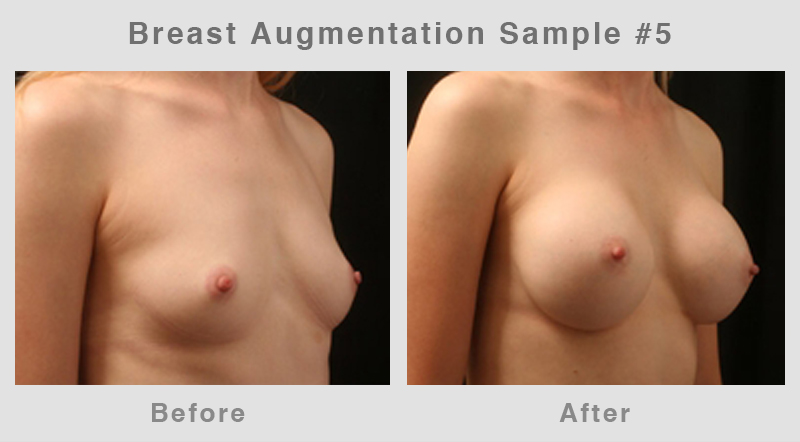 Breast Augmentation Before & After Picture 5