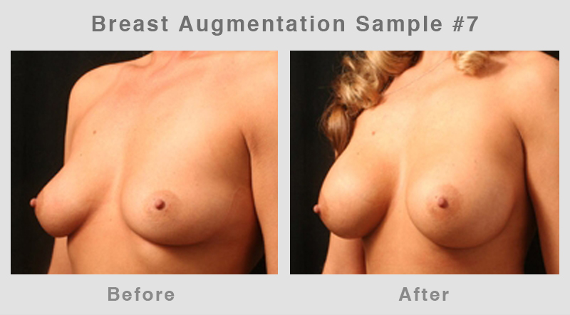 Breast Augmentation Before & After Picture 7