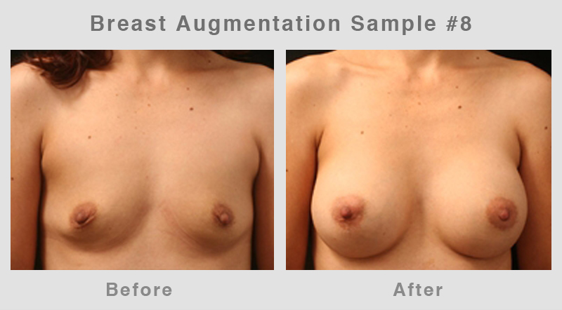 Breast Augmentation Before & After Picture 8