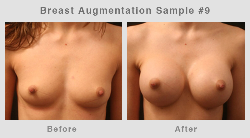 Breast Augmentation Before & After Picture 9