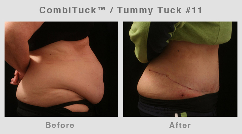 Memphis CombiTuck - Tummy Tuck with Liposuction Example 11