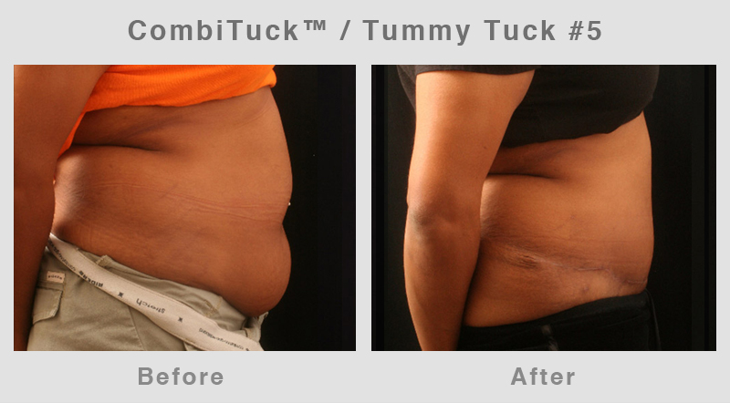 Memphis CombiTuck - Tummy Tuck with Liposuction Example 5