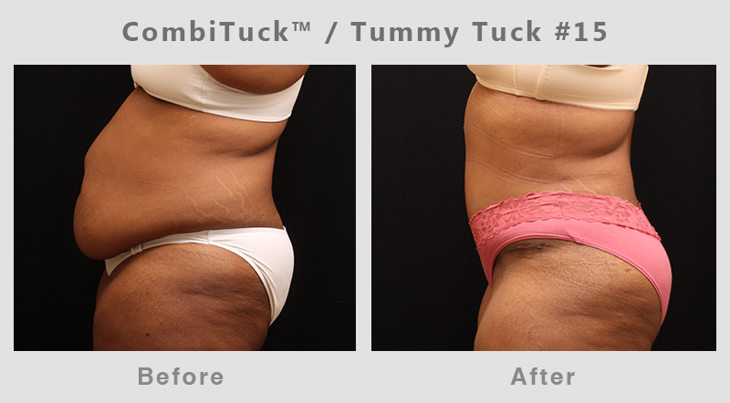 Memphis CombiTuck - Tummy Tuck with Liposuction Example 15