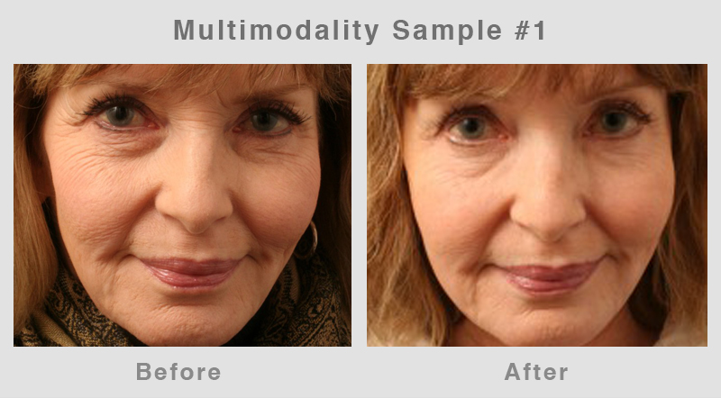 Multimodality1 Eyelid Surgery - Blepharoplasty Before and After Photo1