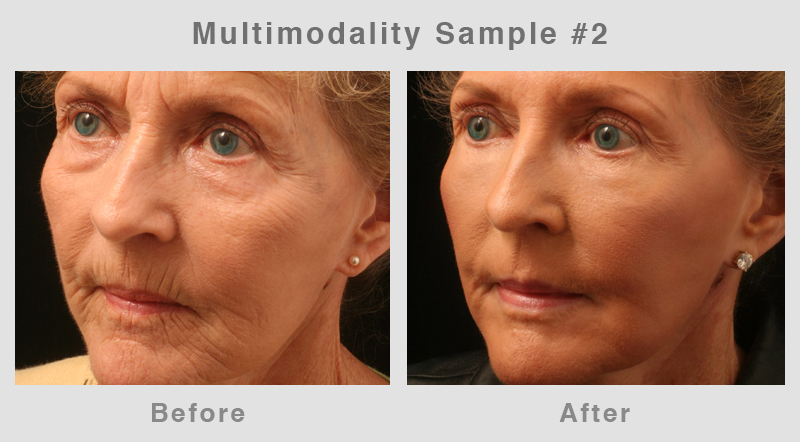 Multimodality2 Eyelid Surgery - Blepharoplasty Before and After Photo2