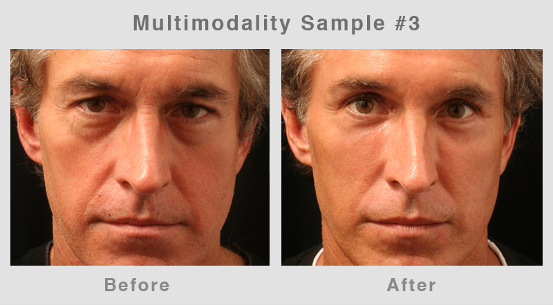 Multimodality3 Eyelid Surgery - Blepharoplasty Before and After Photo3