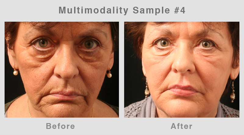 Multimodality4 Eyelid Surgery - Blepharoplasty Before and After Photo4