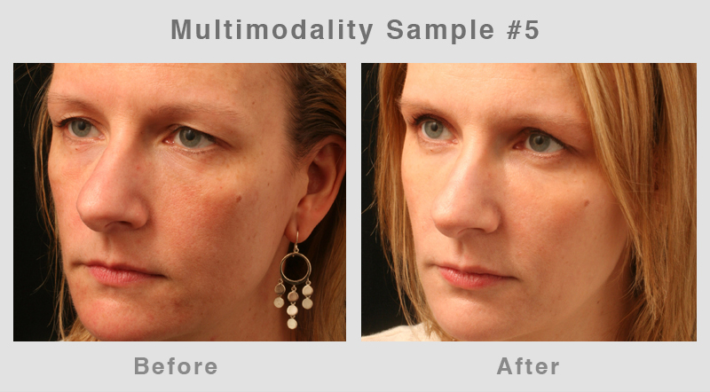 Multimodality5 Eyelid Surgery - Blepharoplasty Before and After Photo5