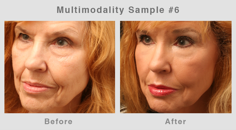 Multimodality6 Eyelid Surgery - Blepharoplasty Before and After Photo6
