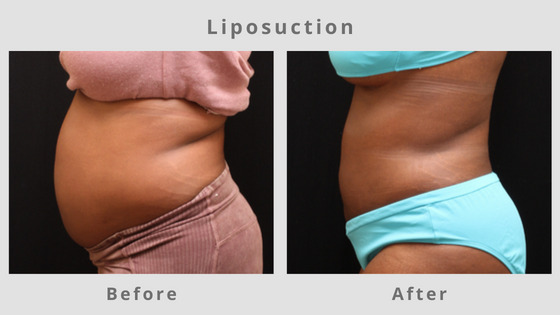 Memphis Liposuction & Fat Removal Example 2